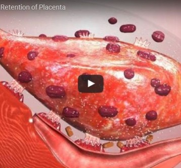 Intas-Retention of Placenta